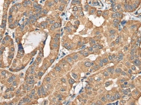 Immunohistochemistry of paraffin-embedded Human thyroid cancer tissue using BCHE Polyclonal Antibody at dilution of 1:40(×200)