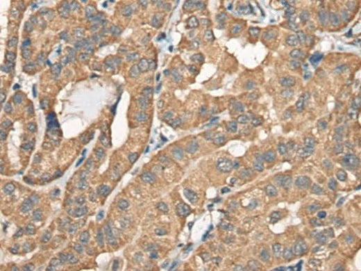 Immunohistochemistry of paraffin-embedded Human thyroid cancer tissue using BCHE Polyclonal Antibody at dilution of 1:40(×200)
