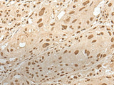 Immunohistochemistry of paraffin-embedded Human esophagus cancer tissue using ZNF274 Polyclonal Antibody at dilution of 1:35(×200)