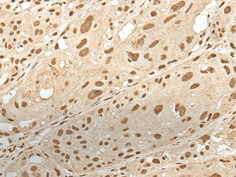 Immunohistochemistry of paraffin-embedded Human esophagus cancer tissue using ZNF274 Polyclonal Antibody at dilution of 1:35(×200)