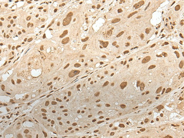 Immunohistochemistry of paraffin-embedded Human esophagus cancer tissue using ZNF274 Polyclonal Antibody at dilution of 1:35(×200)