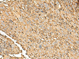 Immunohistochemistry of paraffin-embedded Human cervical cancer tissue using UBE2A Polyclonal Antibody at dilution of 1:45(×200)