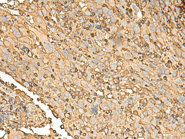 Immunohistochemistry of paraffin-embedded Human cervical cancer tissue using UBE2A Polyclonal Antibody at dilution of 1:45(×200)