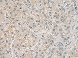 Immunohistochemistry of paraffin-embedded Human liver cancer tissue using WFDC3 Polyclonal Antibody at dilution of 1:40(×200)