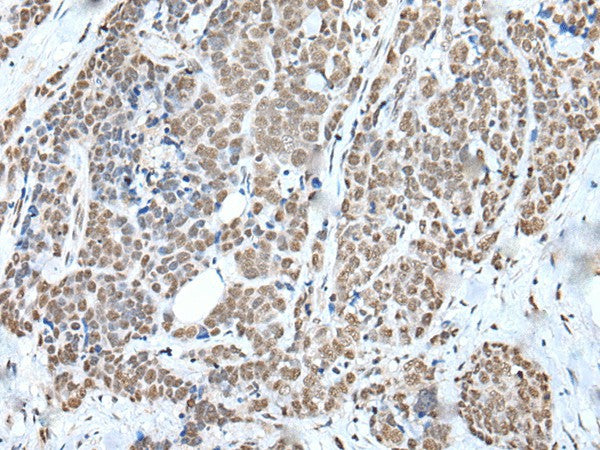 Immunohistochemistry of paraffin-embedded Human thyroid cancer tissue using WTAP Polyclonal Antibody at dilution of 1:35(×200)