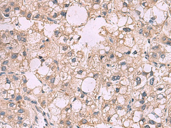 Immunohistochemistry of paraffin-embedded Human liver cancer tissue using KCNIP1 Polyclonal Antibody at dilution of 1:40(×200)