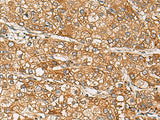 Immunohistochemistry of paraffin-embedded Human liver cancer tissue using DCAF12 Polyclonal Antibody at dilution of 1:65(×200)