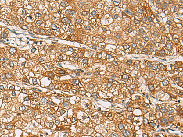 Immunohistochemistry of paraffin-embedded Human liver cancer tissue using DCAF12 Polyclonal Antibody at dilution of 1:65(×200)