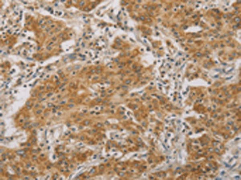 Immunohistochemistry of paraffin-embedded Human gasrtic cancer tissue using CDKN2A Polyclonal Antibody at dilution of 1:50(×200)