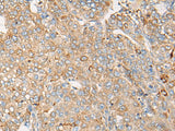 Immunohistochemistry of paraffin-embedded Human liver cancer tissue using CAPN9 Polyclonal Antibody at dilution of 1:45(×200)