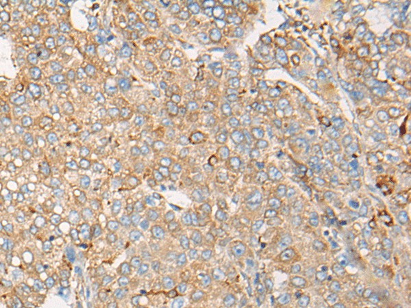 Immunohistochemistry of paraffin-embedded Human liver cancer tissue using CAPN9 Polyclonal Antibody at dilution of 1:45(×200)