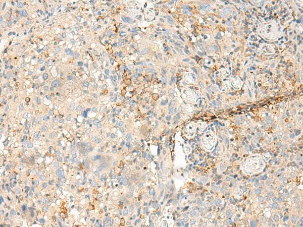 Immunohistochemistry of paraffin-embedded Human cervical cancer tissue using MDFI Polyclonal Antibody at dilution of 1:50(×200)