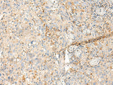 Immunohistochemistry of paraffin-embedded Human cervical cancer tissue using MDFI Polyclonal Antibody at dilution of 1:50(×200)