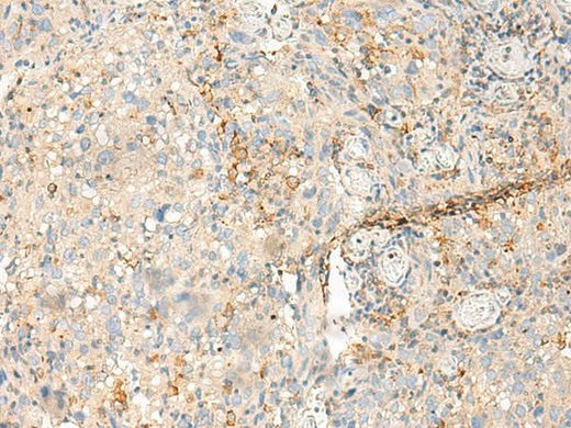Immunohistochemistry of paraffin-embedded Human cervical cancer tissue using MDFI Polyclonal Antibody at dilution of 1:50(×200)