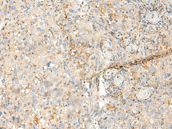 Immunohistochemistry of paraffin-embedded Human cervical cancer tissue using MDFI Polyclonal Antibody at dilution of 1:50(×200)