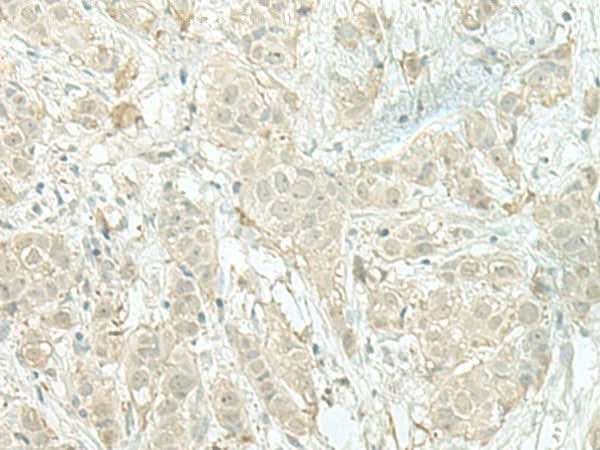 Immunohistochemistry of paraffin-embedded Human breast cancer tissue using MIEN1 Polyclonal Antibody at dilution of 1:100(×200)