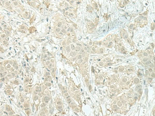 Immunohistochemistry of paraffin-embedded Human breast cancer tissue using MIEN1 Polyclonal Antibody at dilution of 1:100(×200)