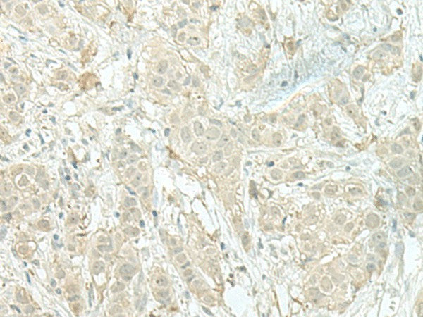 Immunohistochemistry of paraffin-embedded Human breast cancer tissue using MIEN1 Polyclonal Antibody at dilution of 1:100(×200)