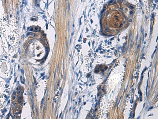 Immunohistochemistry of paraffin-embedded Human esophagus cancer tissue using ICA1 Polyclonal Antibody at dilution of 1:50(×200)