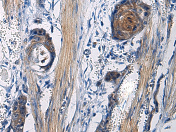 Immunohistochemistry of paraffin-embedded Human esophagus cancer tissue using ICA1 Polyclonal Antibody at dilution of 1:50(×200)