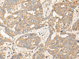 Immunohistochemistry of paraffin-embedded Human liver cancer tissue using CPNE3 Polyclonal Antibody at dilution of 1:40(×200)