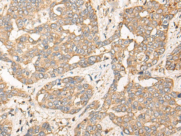 Immunohistochemistry of paraffin-embedded Human liver cancer tissue using CPNE3 Polyclonal Antibody at dilution of 1:40(×200)