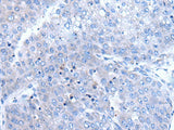 Immunohistochemistry of paraffin-embedded Human liver cancer tissue using BTG4 Polyclonal Antibody at dilution of 1:65(×200)