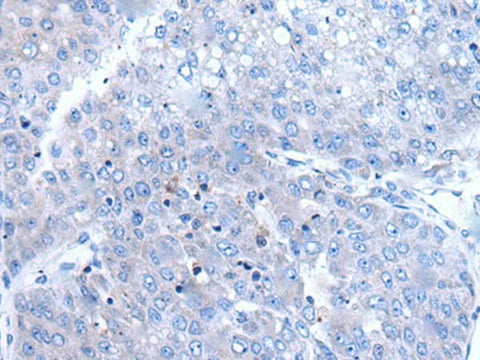 Immunohistochemistry of paraffin-embedded Human liver cancer tissue using BTG4 Polyclonal Antibody at dilution of 1:65(×200)