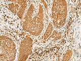 Immunohistochemistry of paraffin-embedded Human esophagus cancer tissue using PPOX Polyclonal Antibody at dilution of 1:30(×200)