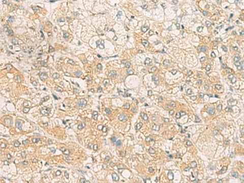 Immunohistochemistry of paraffin-embedded Human liver cancer tissue using SYNGR1 Polyclonal Antibody at dilution of 1:60(×200)
