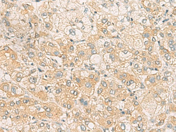 Immunohistochemistry of paraffin-embedded Human liver cancer tissue using SYNGR1 Polyclonal Antibody at dilution of 1:60(×200)