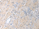Immunohistochemistry of paraffin-embedded Human gastric cancer tissue using GNAI1 Polyclonal Antibody at dilution of 1:130(×200)