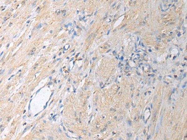 Immunohistochemistry of paraffin-embedded Human gastric cancer tissue using GNAI1 Polyclonal Antibody at dilution of 1:130(×200)