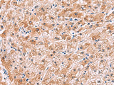 Immunohistochemistry of paraffin-embedded Human liver cancer tissue using IL4R Polyclonal Antibody at dilution of 1:45(×200)
