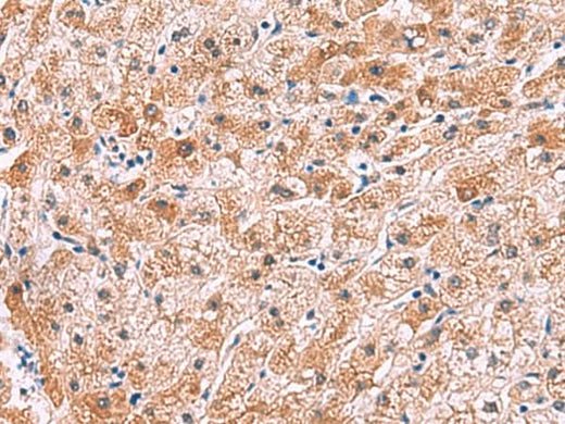 Immunohistochemistry of paraffin-embedded Human liver cancer tissue using IL4R Polyclonal Antibody at dilution of 1:45(×200)