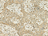 Immunohistochemistry of paraffin-embedded Human ovarian cancer tissue using KAT7 Polyclonal Antibody at dilution of 1:45(×200)