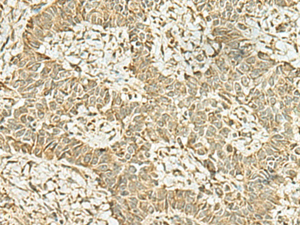 Immunohistochemistry of paraffin-embedded Human ovarian cancer tissue using KAT7 Polyclonal Antibody at dilution of 1:45(×200)