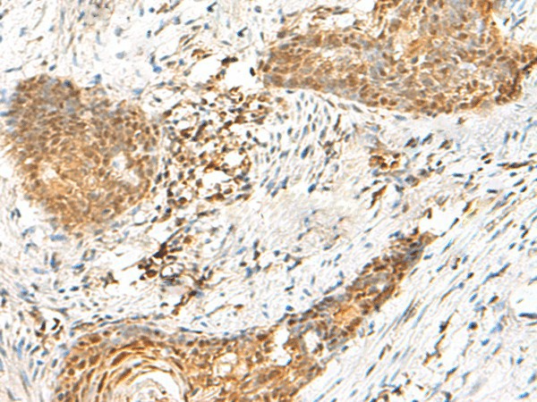 Immunohistochemistry of paraffin-embedded Human esophagus cancer tissue using HMBOX1 Polyclonal Antibody at dilution of 1:60(×200)