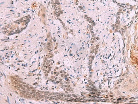Immunohistochemistry of paraffin-embedded Human esophagus cancer tissue using INO80 Polyclonal Antibody at dilution of 1:70(×200)