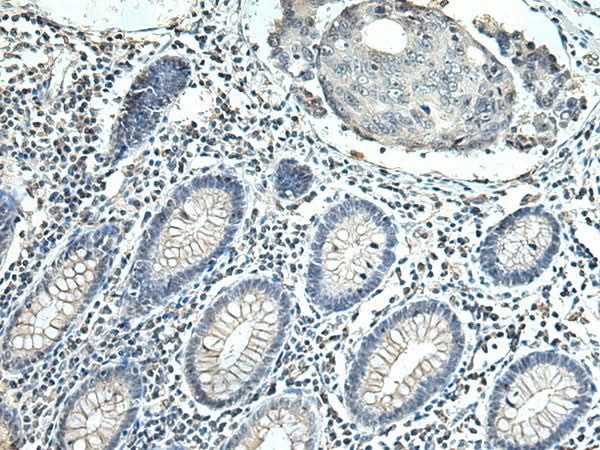 Immunohistochemistry of paraffin-embedded Human colorectal cancer tissue using SLC35F6 Polyclonal Antibody at dilution of 1:115(×200)