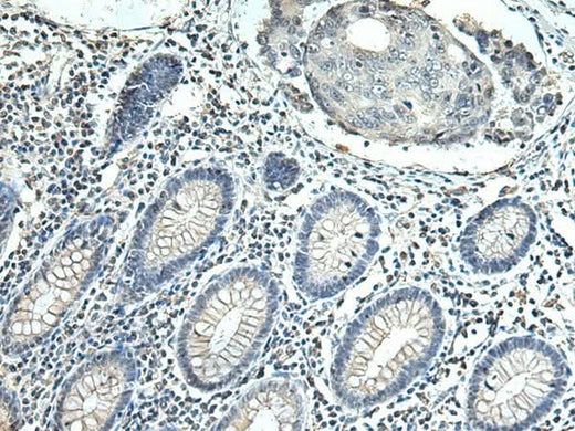 Immunohistochemistry of paraffin-embedded Human colorectal cancer tissue using SLC35F6 Polyclonal Antibody at dilution of 1:115(×200)