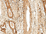 Immunohistochemistry of paraffin-embedded Human breast cancer tissue using GPR27 Polyclonal Antibody at dilution of 1:60(×200)