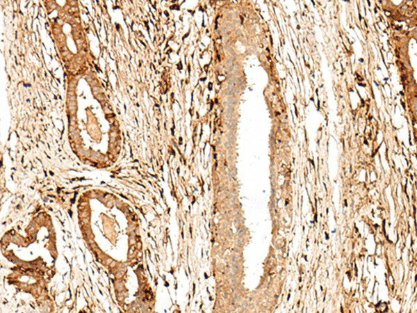 Immunohistochemistry of paraffin-embedded Human breast cancer tissue using GPR27 Polyclonal Antibody at dilution of 1:60(×200)