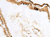 Immunohistochemistry of paraffin-embedded Human thyroid cancer tissue using RABGGTA Polyclonal Antibody at dilution of 1:50(×200)