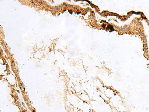 Immunohistochemistry of paraffin-embedded Human thyroid cancer tissue using RABGGTA Polyclonal Antibody at dilution of 1:50(×200)