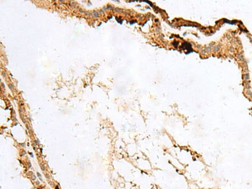 Immunohistochemistry of paraffin-embedded Human thyroid cancer tissue using RABGGTA Polyclonal Antibody at dilution of 1:50(×200)