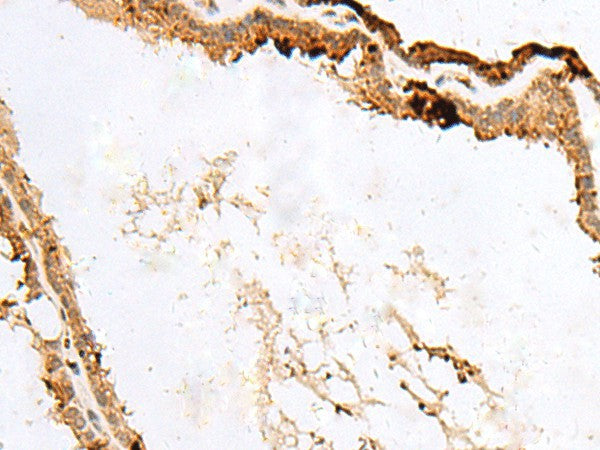 Immunohistochemistry of paraffin-embedded Human thyroid cancer tissue using RABGGTA Polyclonal Antibody at dilution of 1:50(×200)