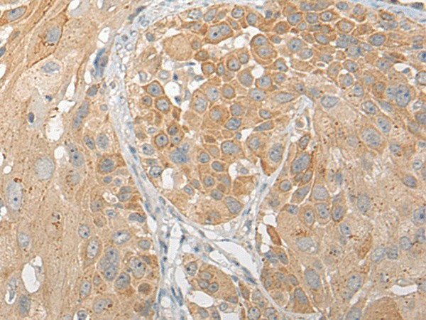 Immunohistochemistry of paraffin-embedded Human esophagus cancer tissue using SNX6 Polyclonal Antibody at dilution of 1:50(×200)