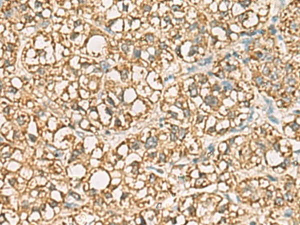 Immunohistochemistry of paraffin-embedded Human liver cancer tissue using VTA1 Polyclonal Antibody at dilution of 1:85(×200)