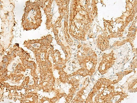 Immunohistochemistry of paraffin-embedded Human thyroid cancer tissue using ADGRF1 Polyclonal Antibody at dilution of 1:25(×200)